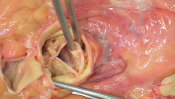 Still medium pathocast  20aortenklappenstenose