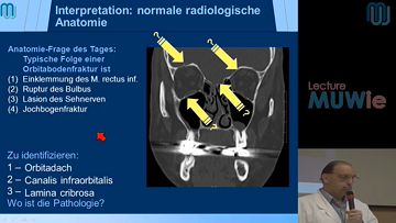 Still medium fallkonferenz 2013 06 10 66jhg patient mit veilchenauge kainberger